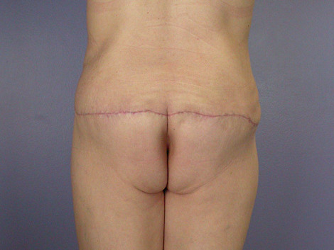 Tummy Tuck before and after photo