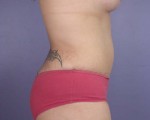 Tummy Tuck Before and after photo