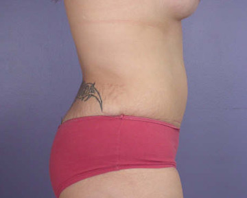 Tummy Tuck before and after photo