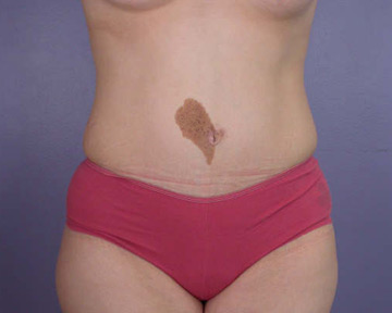 Tummy Tuck before and after photo