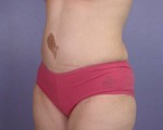 Tummy Tuck Before and after photo