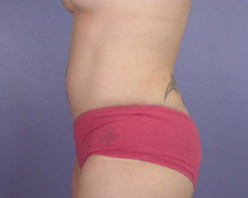 Tummy Tuck before and after photo