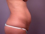 Tummy Tuck Before and after photo
