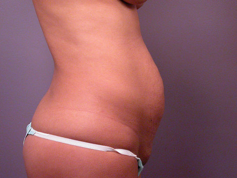 Tummy Tuck before and after photo