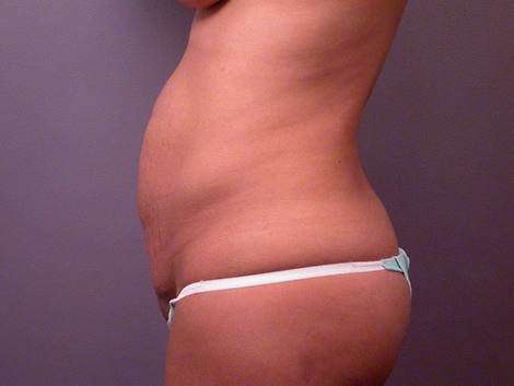 Tummy Tuck before and after photo