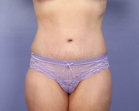 Tummy Tuck before and after photo