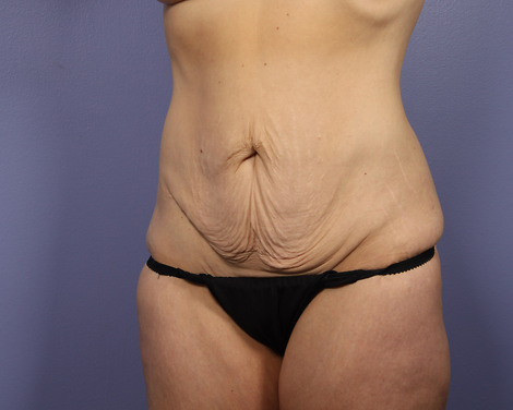 Tummy Tuck before and after photo