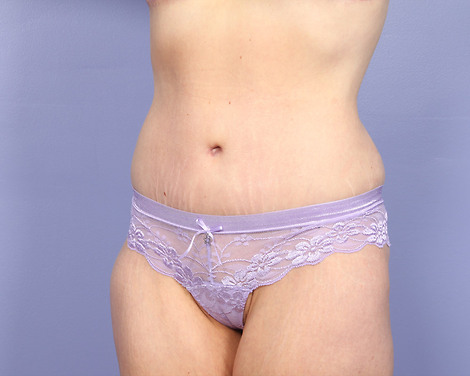 Tummy Tuck before and after photo