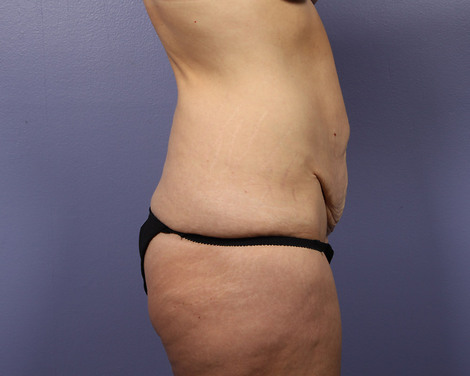 Tummy Tuck before and after photo