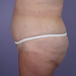 Tummy Tuck Before and after photo