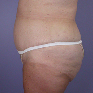 Tummy Tuck before and after photo