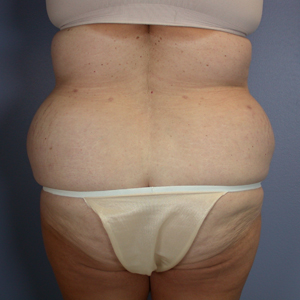 Tummy Tuck before and after photo