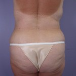 Tummy Tuck Before and after photo