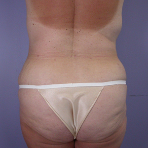 Tummy Tuck before and after photo