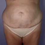 Tummy Tuck