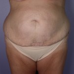 Tummy Tuck Before and after photo