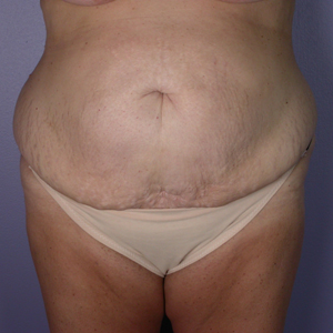 Tummy Tuck before and after photo