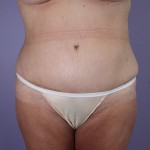 Tummy Tuck Before and after photo