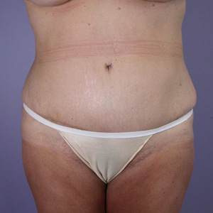 Tummy Tuck before and after photo