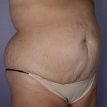 Tummy Tuck Before and after photo