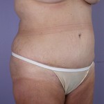 Tummy Tuck Before and after photo