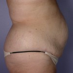 Tummy Tuck Before and after photo