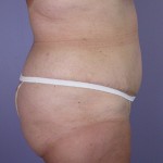 Tummy Tuck Before and after photo