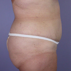 Tummy Tuck before and after photo