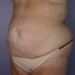 Tummy Tuck Before and after photo