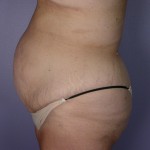 Tummy Tuck Before and after photo