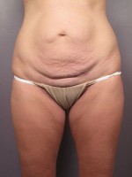 Tummy Tuck Before and after photo