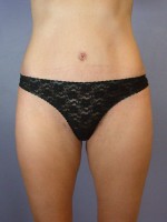 Tummy Tuck Before and after photo