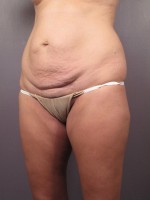 Tummy Tuck Before and after photo