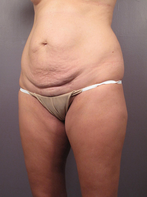 Tummy Tuck before and after photo