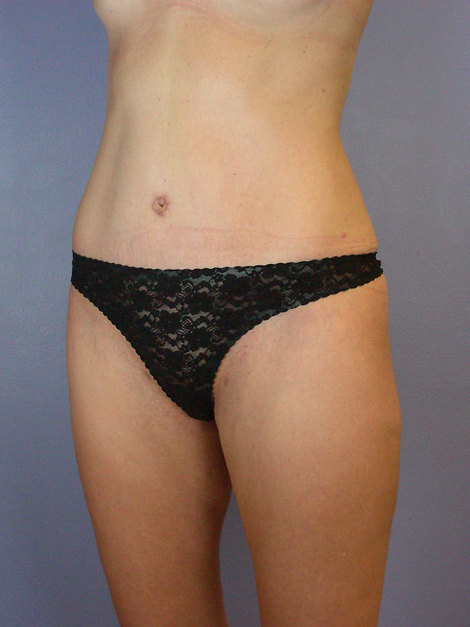 Tummy Tuck before and after photo