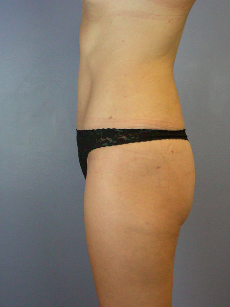 Tummy Tuck before and after photo