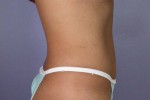 Tummy Tuck Before and after photo