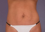 Tummy Tuck Before and after photo