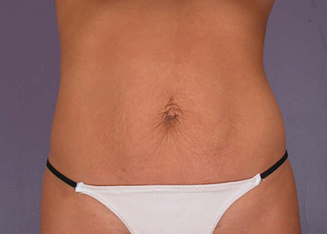 Tummy Tuck before and after photo