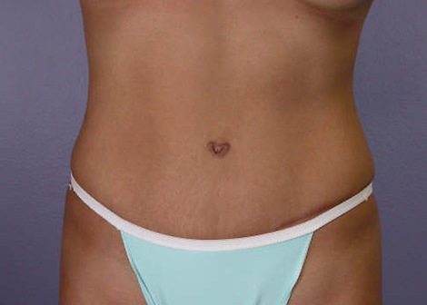 Tummy Tuck before and after photo