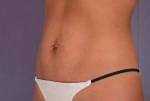 Tummy Tuck Before and after photo