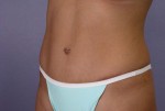 Tummy Tuck Before and after photo