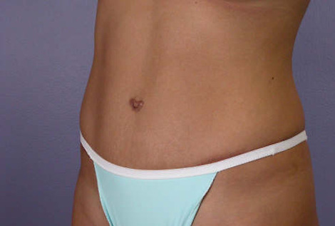 Tummy Tuck before and after photo