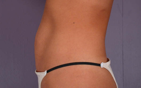 Tummy Tuck before and after photo