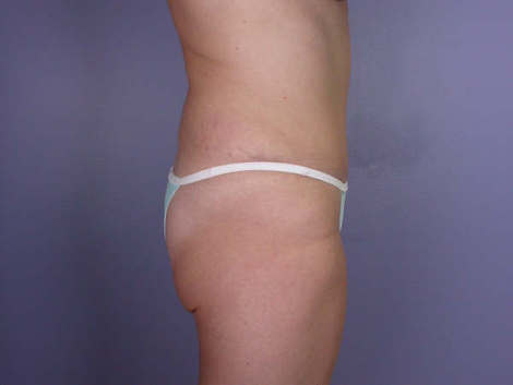 Tummy Tuck before and after photo