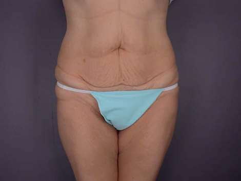 Tummy Tuck before and after photo