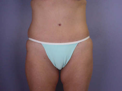 Tummy Tuck before and after photo