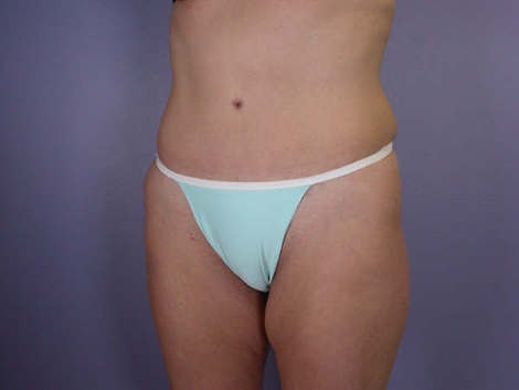 Tummy Tuck before and after photo