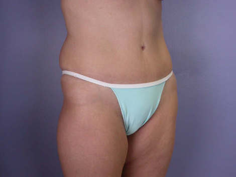 Tummy Tuck before and after photo