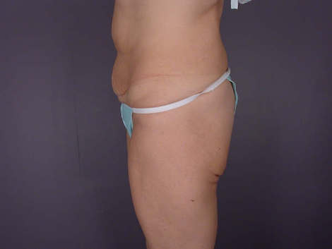 Tummy Tuck before and after photo